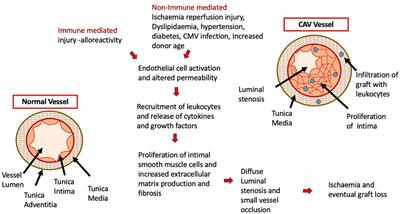 The potential of autologous regulatory T cell (Treg) therapy to prevent Cardiac Allograft Vasculopathy (CAV) in paediatric heart transplant recipients